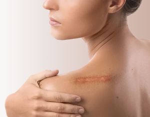 Rētu un veidojumu plastika