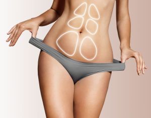 3D liposakcija (tauku atsūkšana)