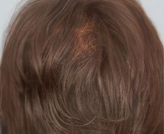 Hair loss treatment and hair strengthening After