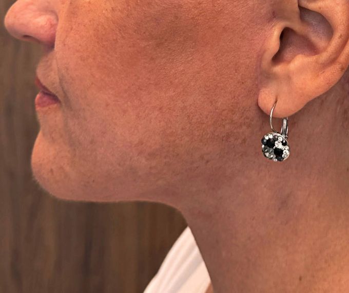 Sejas un kakla plastika - Facelift