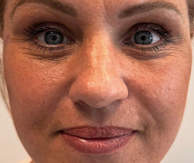 Sejas un kakla plastika - Facelift