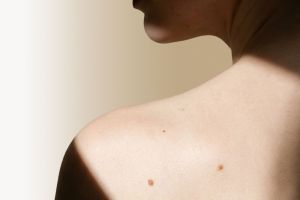 Ādas veidojumu diagnostika un noņemšana