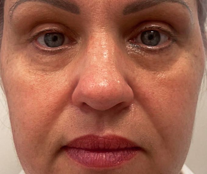 Sejas un kakla plastika - Facelift