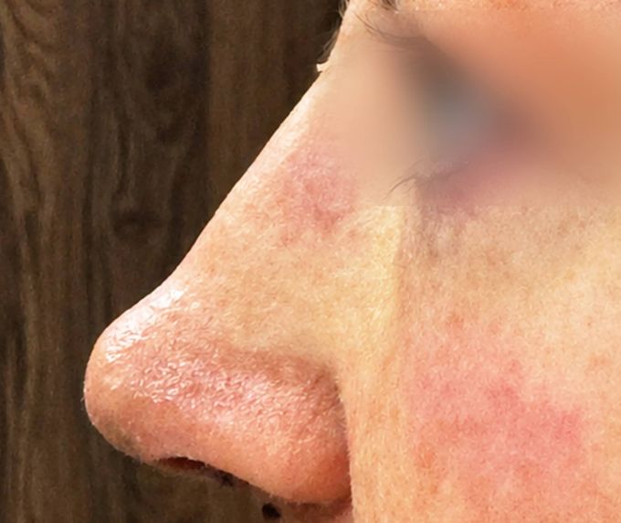 Degunu plastika – Rinoplastika