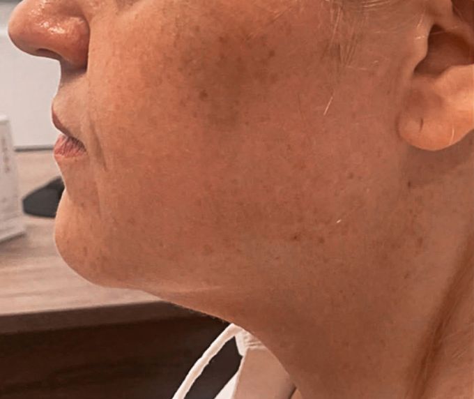 Sejas un kakla plastika - Facelift