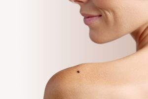 Ādas veidojumu noņemšana