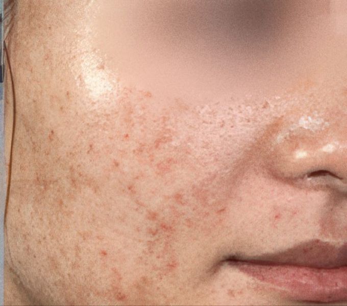 Acne treatment with IPL