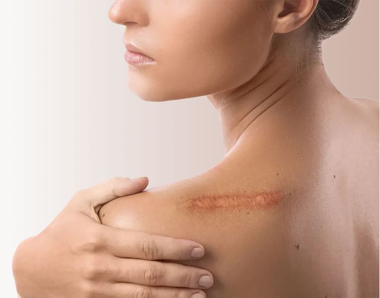 Rētu un veidojumu plastika