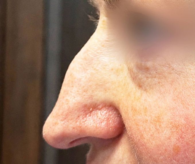 Degunu plastika – Rinoplastika