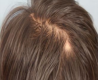 Hair loss treatment and hair strengthening before