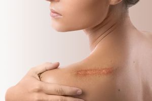 Rētu un veidojumu plastika